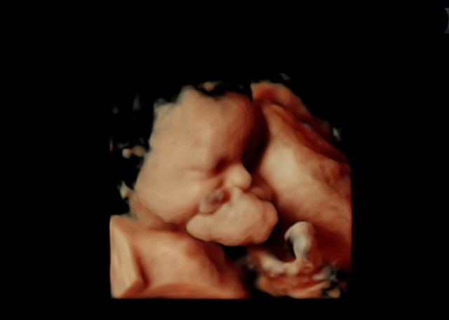 La Arrixaca realiza la primera cirugía EXIT en la Región a un feto de 34 semanas - 2, Foto 2