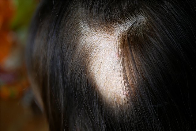 Alopecia femenina: un problema silencioso pero cada vez más frecuente - 1, Foto 1