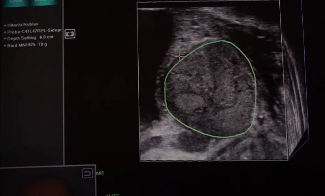Paracelso Sagasta, pionero en aplicar láser mediante ablación térmica para tratar el cáncer de próstata - 1, Foto 1