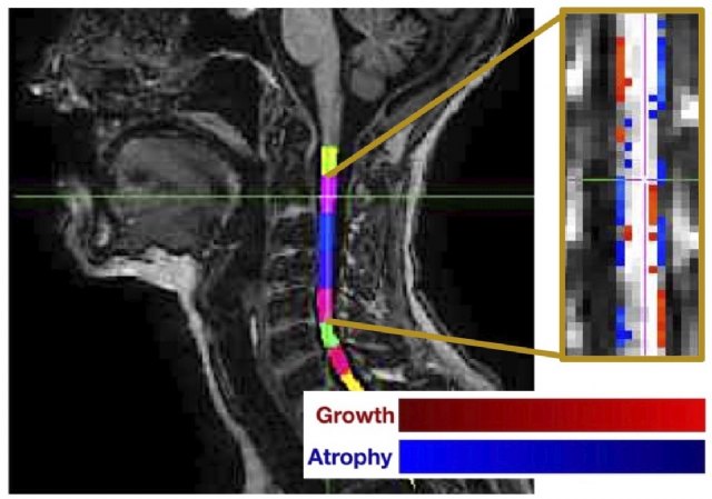 Observación del grado de atrofia de la médula espinal , Foto 1