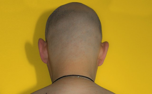 Las consultas online sobre injertos capilares aumentan en un 150% durante el COVID-19 - 1, Foto 1