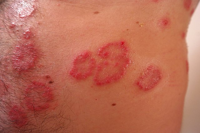 Dermatólogos de la Región de Murcia se reúnen para avanzar en el abordaje de la psoriasis - 1, Foto 1