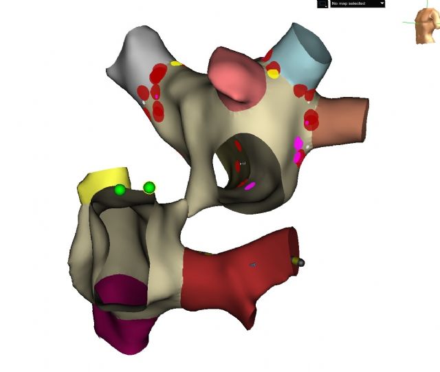 Reconstrucción con el navegador de un caso real de FA, Foto 1