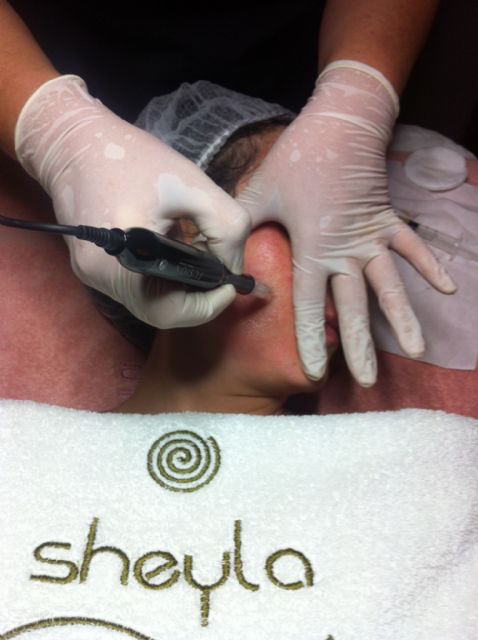 Arrugas, patas de gallo, falta de firmeza, cicatrices ..?, Foto 2