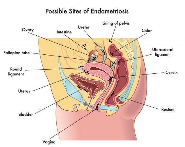 Día mundial de la endometriosis - 1, Foto 1