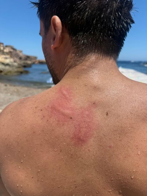 Ni agua dulce para las medusas ni hielo directo: los errores más frecuentes ante las picaduras del verano - 2, Foto 2