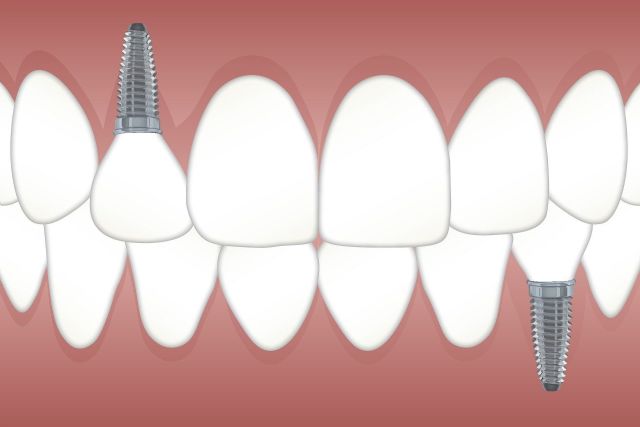 Ventaja que ofrecen los implantes dentales - 1, Foto 1