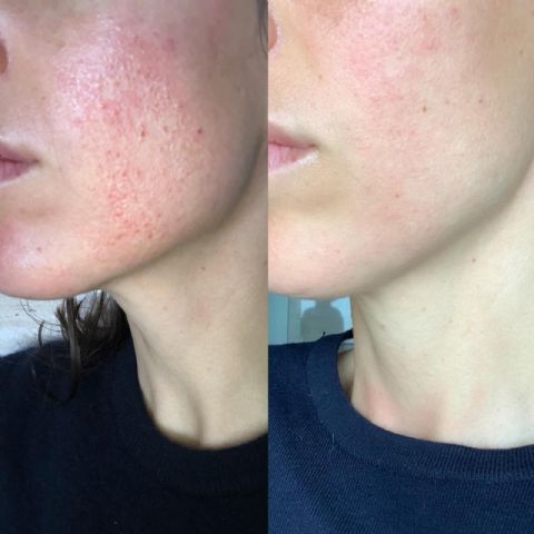 Beauté Mediterránea: ¿Maskné tras usar la mascarilla? - 1, Foto 1