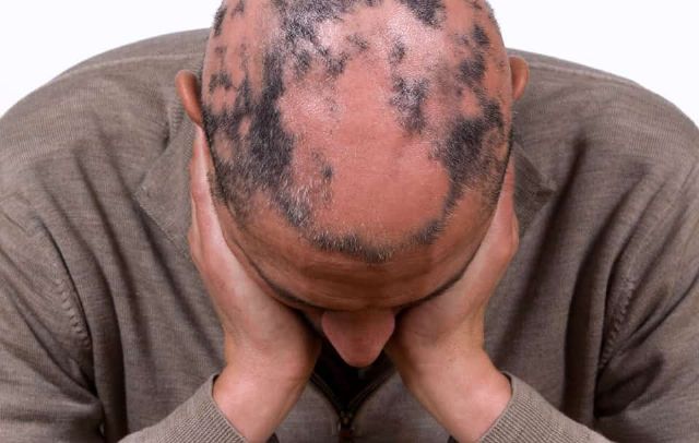 Efectos secundarios del Trasplante Capilar ¿son reales? según el Dr Carlos Crespo - 1, Foto 1