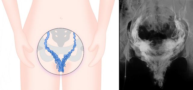 Expertos avisan de que las varices genitales alteran en gran medida la calidad de vida de las pacientes - 1, Foto 1