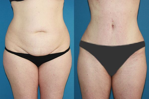 Abdominoplastia Tulua HD, lo último en cirugía estética para corregir el abdomen y crear un nuevo ombligo - 1, Foto 1