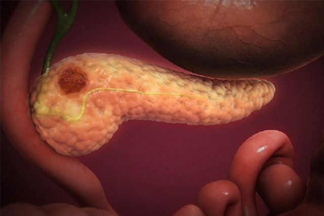 Un estudio coliderado por el CSIC identifica un nuevo biomarcador para el diagnóstico precoz del cáncer de páncreas - 1, Foto 1