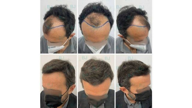 El Dr. Bruno Jacobovski explica los beneficios del Plasma Rico en Plaquetas (PRP) - 1, Foto 1