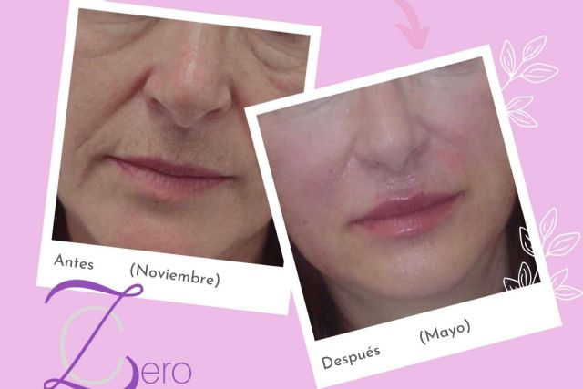 Combatir la flacidez con los hilos tensores de la mano de la Clínica Zero - 1, Foto 1