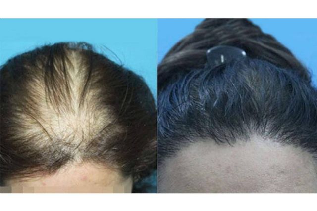 Trasplante capilar para mujeres que sufren alopecia femenina, por la clínica Innovación Capilar - 1, Foto 1