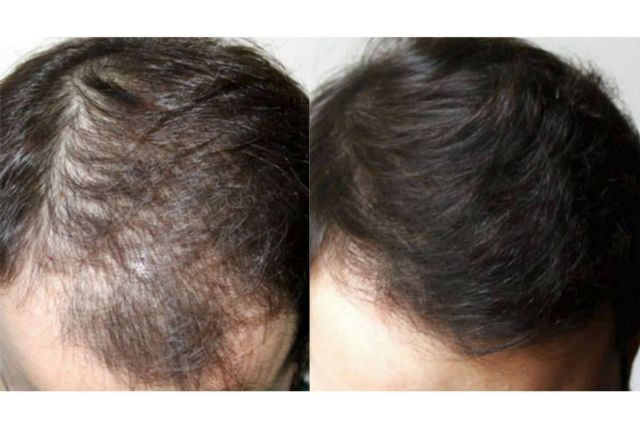 Tratamientos efectivos para alopecia androgenética en Innovación Capilar - 1, Foto 1