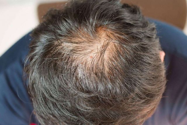 Kmax consigue combatir la caída del cabello a través de péptidos de cobre - 1, Foto 1