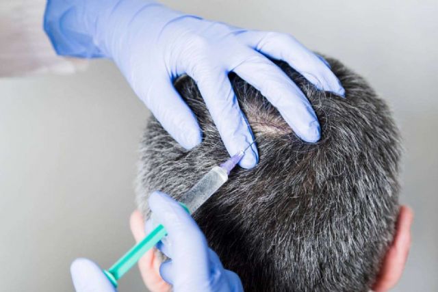 La Clínica Capilar Laura Agrelo explica los diferentes tipos de alopecia - 1, Foto 1