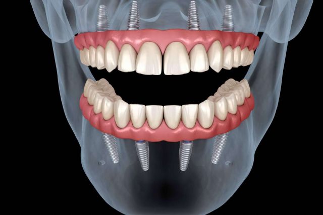 Los instrumentos para la óptima confección de las prótesis dentales de Precisión Médica Dental - 1, Foto 1