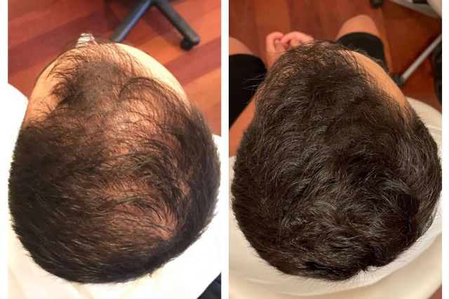 Infiltraciones dutasteride para tratar la alopecia, de la mano de la clínica dermatológica De Felipe - 1, Foto 1