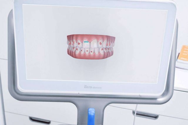La ortodoncia invisible Invisalign, la alternativa perfecta a los brackets - 1, Foto 1