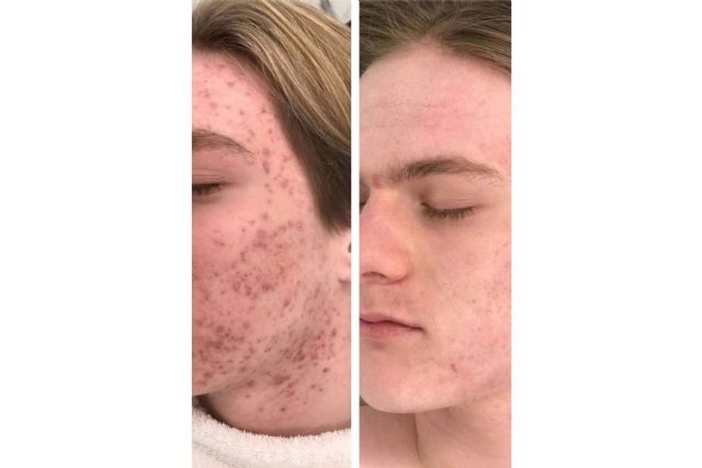 Los tratamientos adecuados para tratar los diferentes tipos de acné - 1, Foto 1