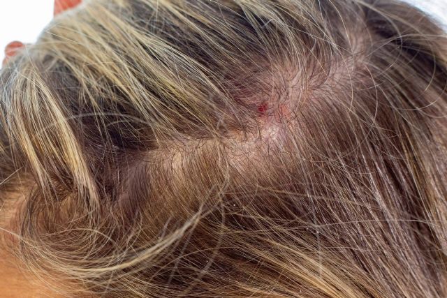 EMPRESA / Dermatitis es una afección que puede alopecia si no se trata - murcia.com