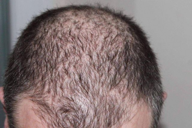 Contra la alopecia androgenética, la mesoterapia capilar con antiandrógenos se establece como un arma eficaz - 1, Foto 1