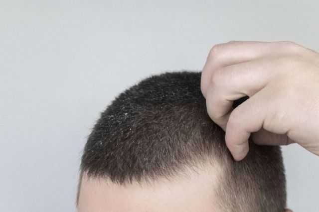 ¿Es culpable la caspa de la caída del cabello? - 1, Foto 1