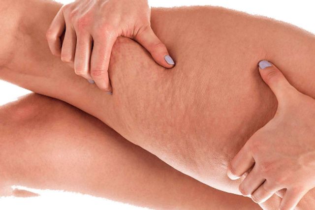 Soluciones ofrece sensores especiales para identificar el nivel de la celulitis, a fin de determinar los procesos y terapias acertadas - 1, Foto 1