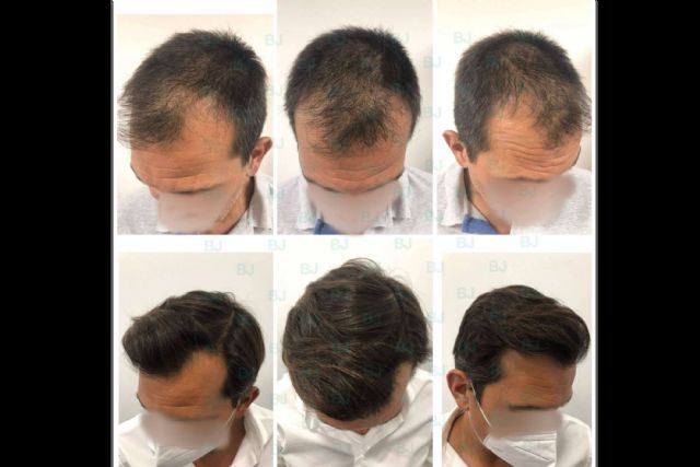 El Dr. Bruno Jacobovski emplea las últimas técnicas del mercado a la hora de realizar un tratamiento capilar - 1, Foto 1