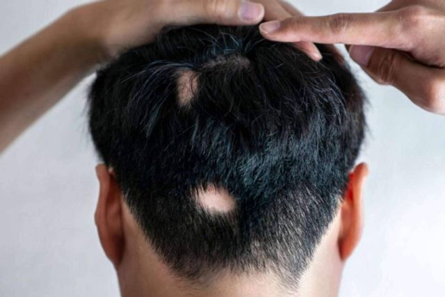 En qué consiste la alopecia areata y cómo disminuirla - 1, Foto 1