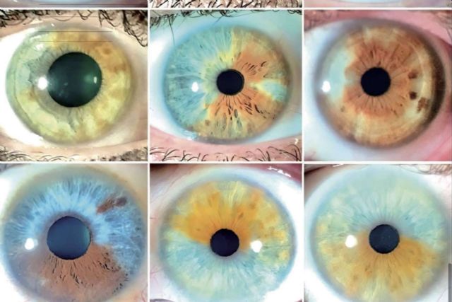El gran libro Atlas sobre el cambio de color de ojos con láser, con Eyecos - 1, Foto 1
