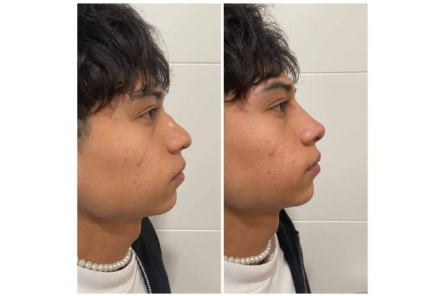 Rinomodelación sin cirugía de forma exitosa en Cecilia Arthur - 1, Foto 1