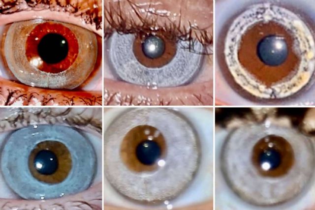 Clínica Eyecos explica cuáles son las ventajas del láser NewEyes frente a la queratopigmentación - 1, Foto 1