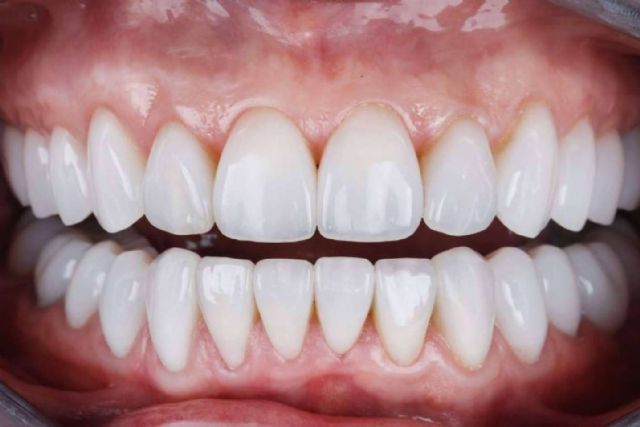 Clínica Dental Ruiz de Gopegui explica los beneficios de las carillas de composite - 1, Foto 1