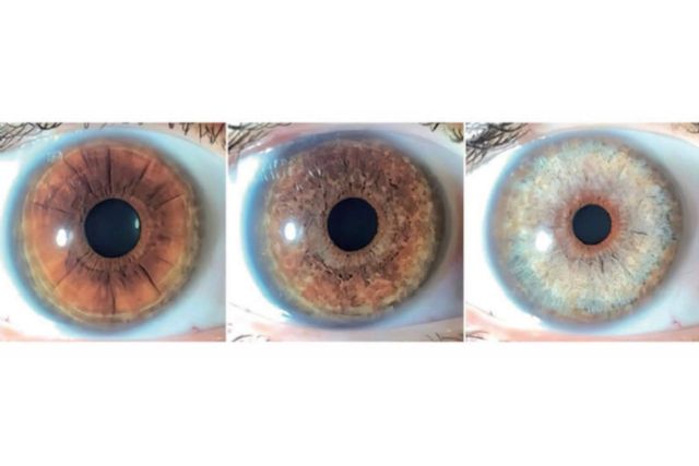 Clínica Eyecos expone que los productos crece pestañas pueden ocasionar un oscurecimiento de los ojos - 1, Foto 1