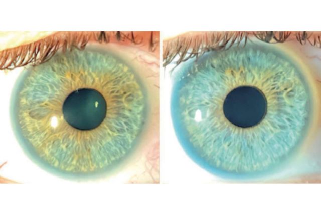 Los heterocromías y los nevus del iris pueden ser tratados con láser según Clínica Eyecos - 1, Foto 1