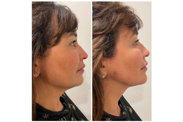 Resultados antes y después de los hilos tensores, por la Dra. Cecilia Arthur - 1, Foto 1