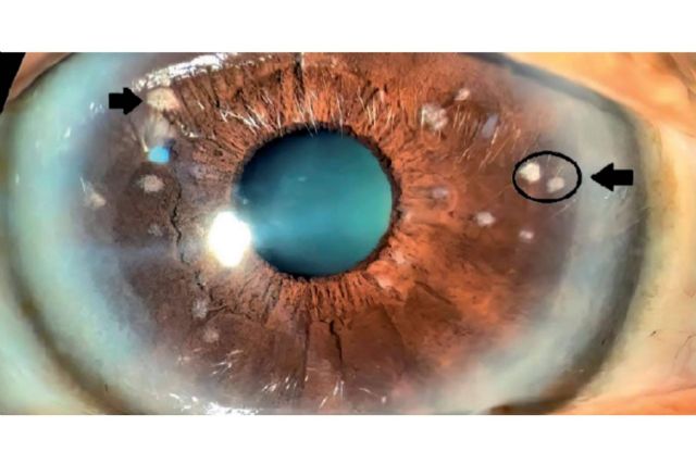 Iridoplastia láser; una opción para el tratamiento del vitiligo ocular - 1, Foto 1