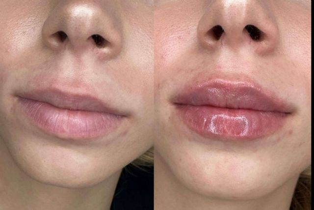 Conseguir unos labios 100 % naturales gracias a la técnica en dos pasos de la doctora Sandra Hermida - 1, Foto 1