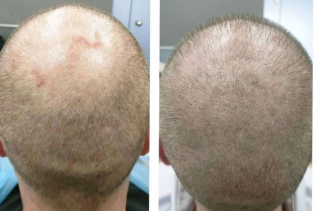 Las ventajas de la micropigmentación capilar, por Dermopigmentación Clínica - 1, Foto 1