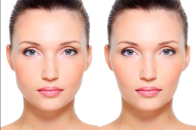 Bichectomía química, la innovadora técnica del Dr. Tallaj que elimina las bolsas de Bichat sin pasar por quirófano - 1, Foto 1