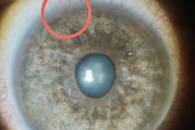 En qué consiste el tratamiento láser de las manchas pigmentarias de la conjuntiva - 1, Foto 1