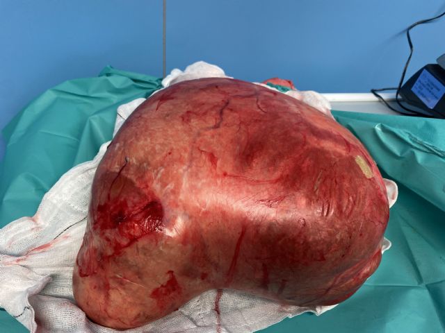 Dr. Koldo Carbonero y el equipo de Quirónsalud Gipuzkoa consiguen extirpar un quiste ovárico de 8 kilos de peso - 1, Foto 1