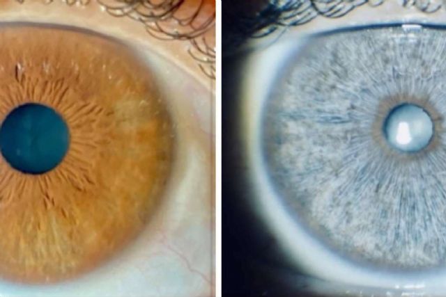 Clínica Eyecos avisa de que los sueros crece pestañas pueden oscurecer los ojos de forma permanente - 1, Foto 1