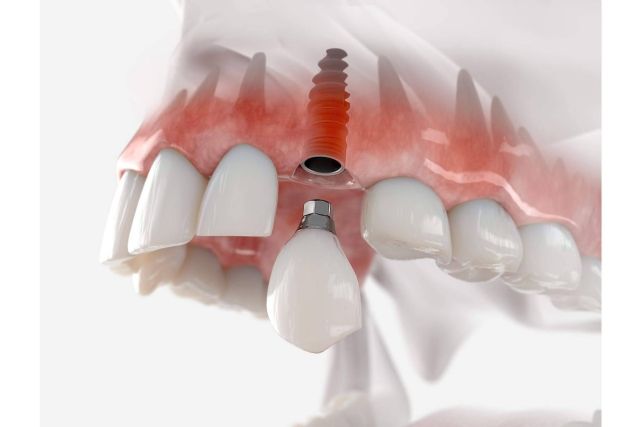 Las ventajas de un implante dental en DeltaDent - 1, Foto 1