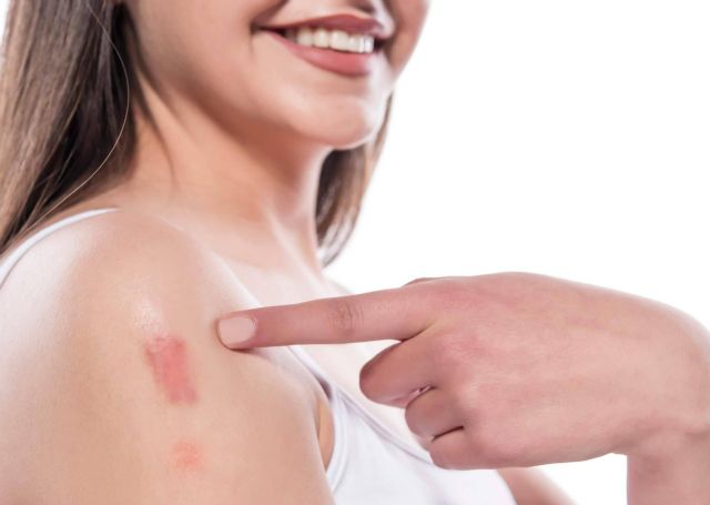 Eliminar cicatrices con las técnicas más avanzadas de Centro Estética El Pilar - 1, Foto 1