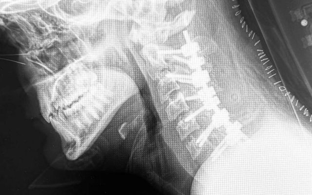 Cifosis post-laminectomía cervical - 1, Foto 1