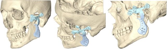 La reconstrucción de la articulación temporomandibular por un tumor requiere diseñar una prótesis a medida - 1, Foto 1